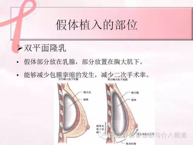 【PPT】隆乳术及其MRI表现