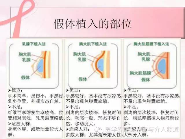 【PPT】隆乳术及其MRI表现