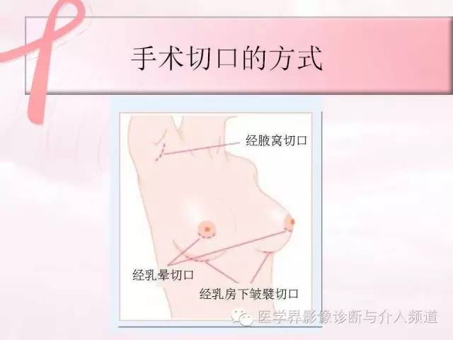 【PPT】隆乳术及其MRI表现