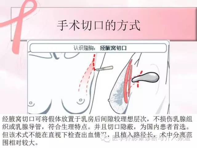 【PPT】隆乳术及其MRI表现