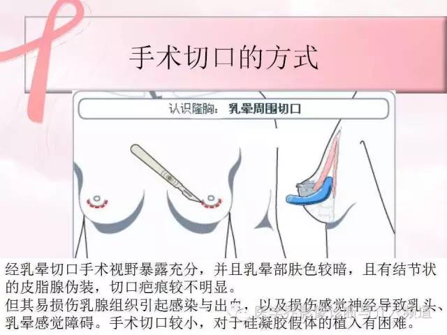 【PPT】隆乳术及其MRI表现