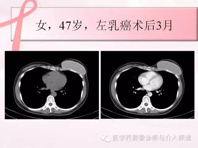 【PPT】隆乳术及其MRI表现
