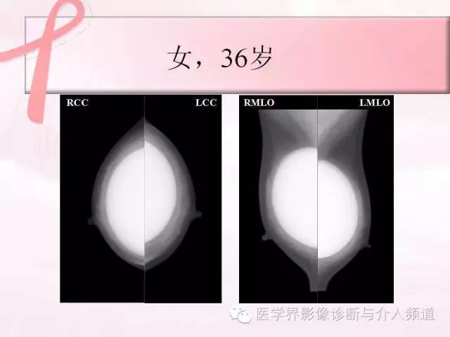 【PPT】隆乳术及其MRI表现