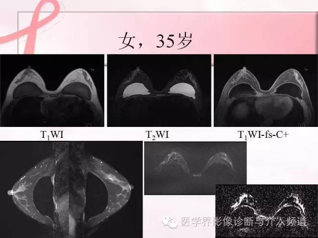 【PPT】隆乳术及其MRI表现