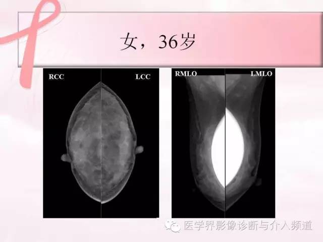 【PPT】隆乳术及其MRI表现