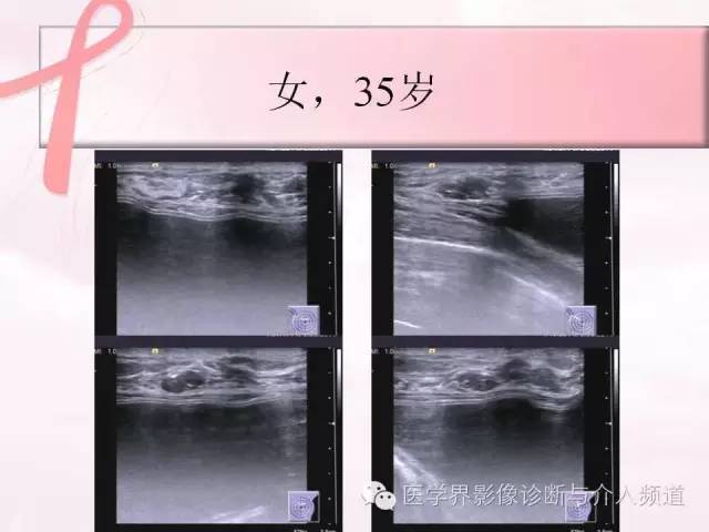 【PPT】隆乳术及其MRI表现