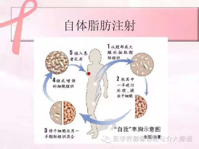 【PPT】隆乳术及其MRI表现