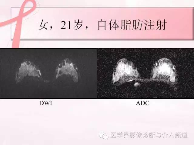 【PPT】隆乳术及其MRI表现