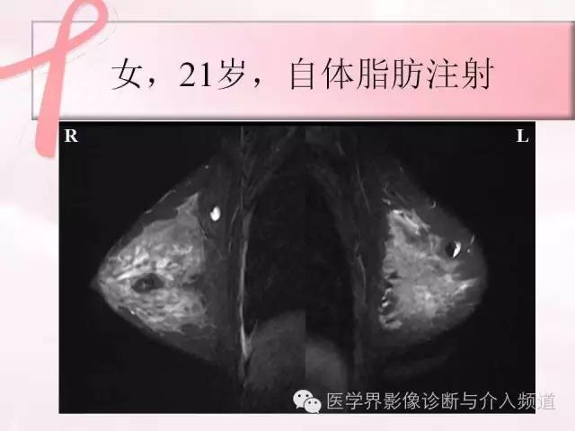 【PPT】隆乳术及其MRI表现