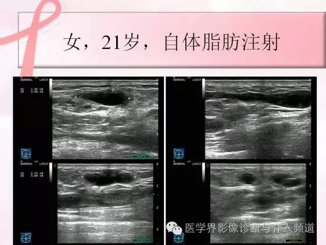 【PPT】隆乳术及其MRI表现