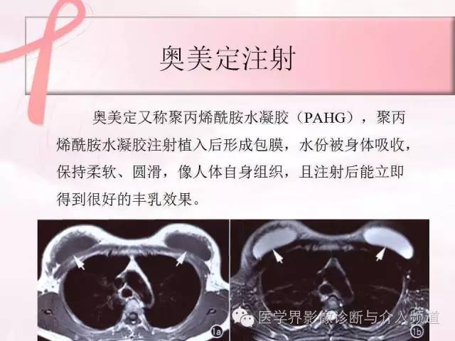【PPT】隆乳术及其MRI表现