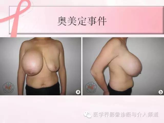 【PPT】隆乳术及其MRI表现