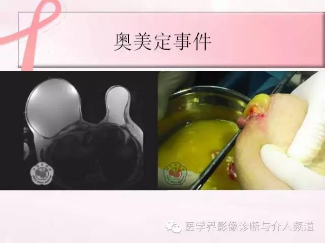 【PPT】隆乳术及其MRI表现