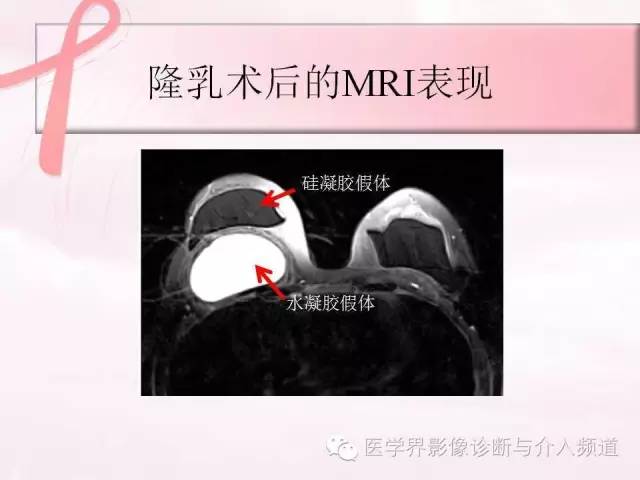 【PPT】隆乳术及其MRI表现