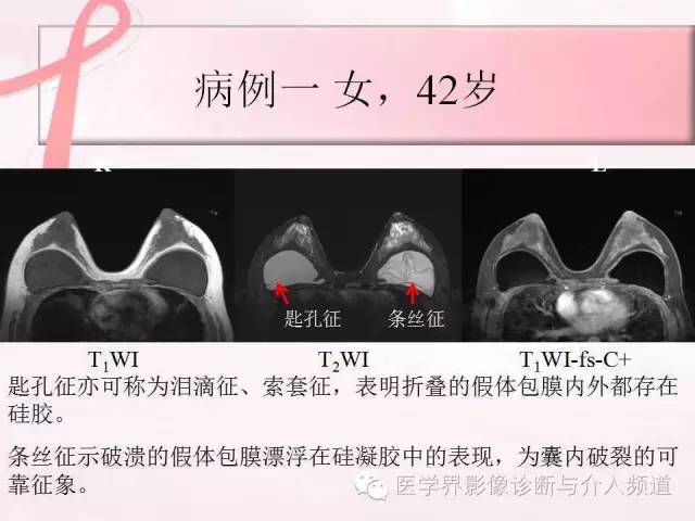 【PPT】隆乳术及其MRI表现