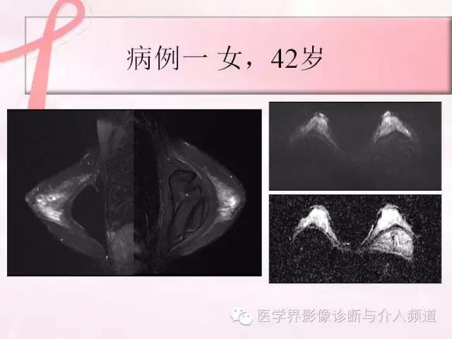 【PPT】隆乳术及其MRI表现