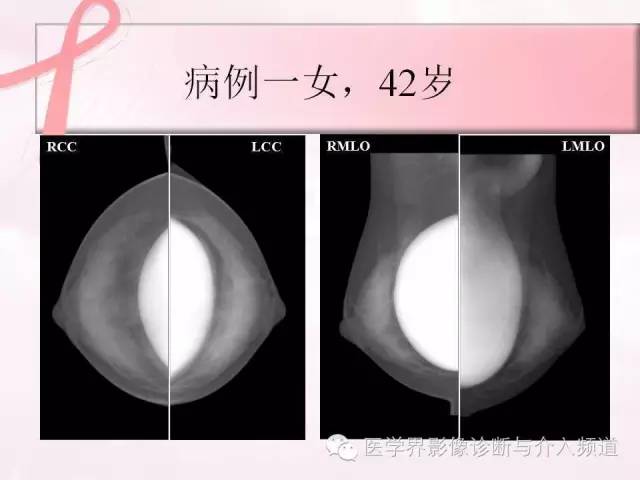 【PPT】隆乳术及其MRI表现