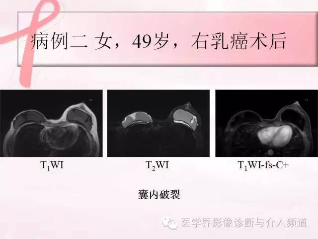 【PPT】隆乳术及其MRI表现
