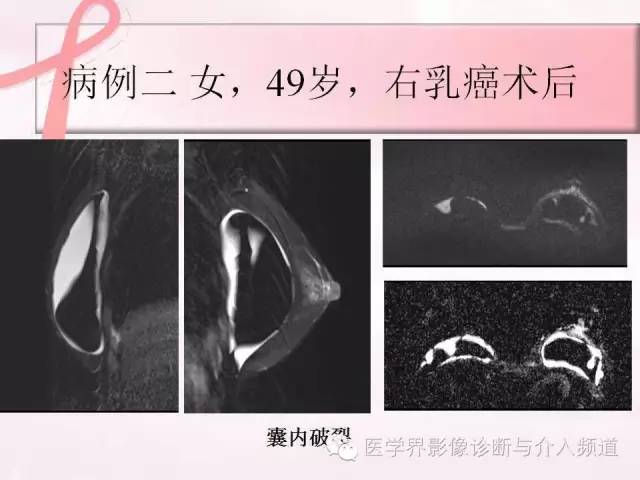 【PPT】隆乳术及其MRI表现
