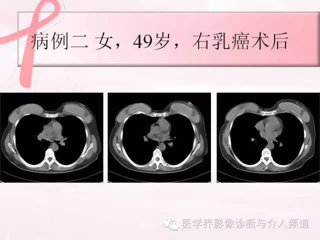 【PPT】隆乳术及其MRI表现