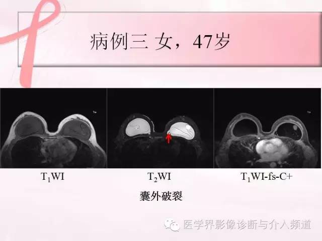 【PPT】隆乳术及其MRI表现