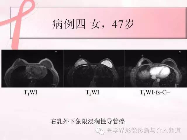 【PPT】隆乳术及其MRI表现