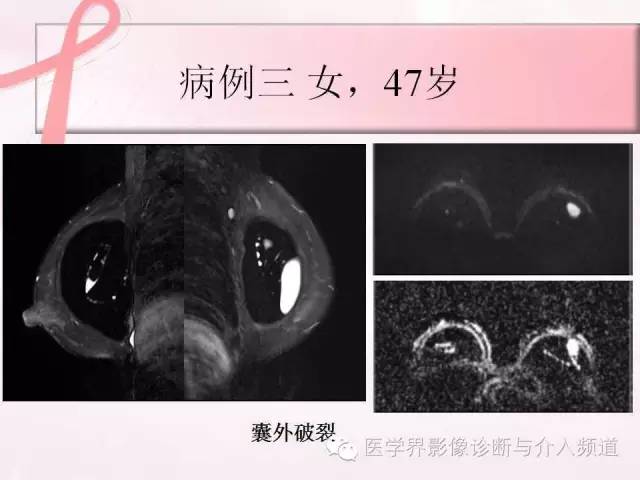 【PPT】隆乳术及其MRI表现