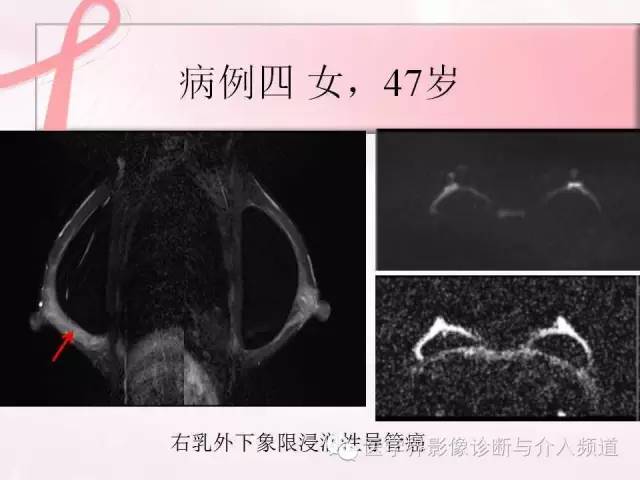 【PPT】隆乳术及其MRI表现