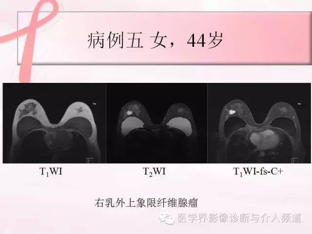 【PPT】隆乳术及其MRI表现