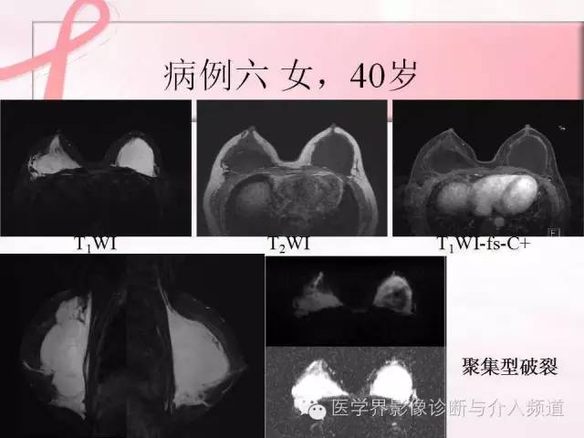 【PPT】隆乳术及其MRI表现
