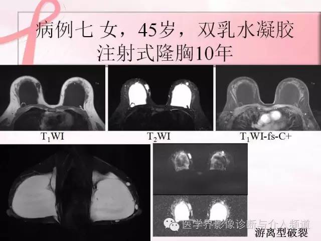 【PPT】隆乳术及其MRI表现