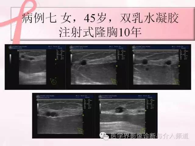 【PPT】隆乳术及其MRI表现