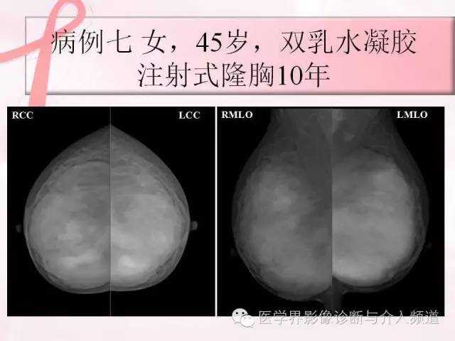 【PPT】隆乳术及其MRI表现