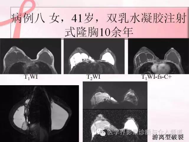 【PPT】隆乳术及其MRI表现