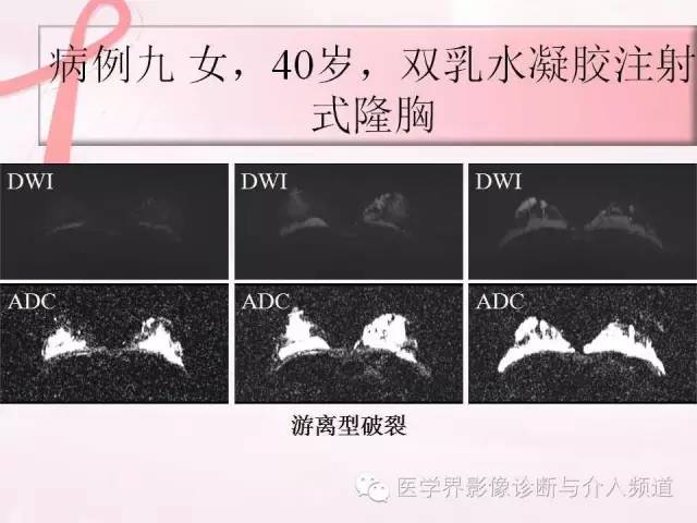 【PPT】隆乳术及其MRI表现