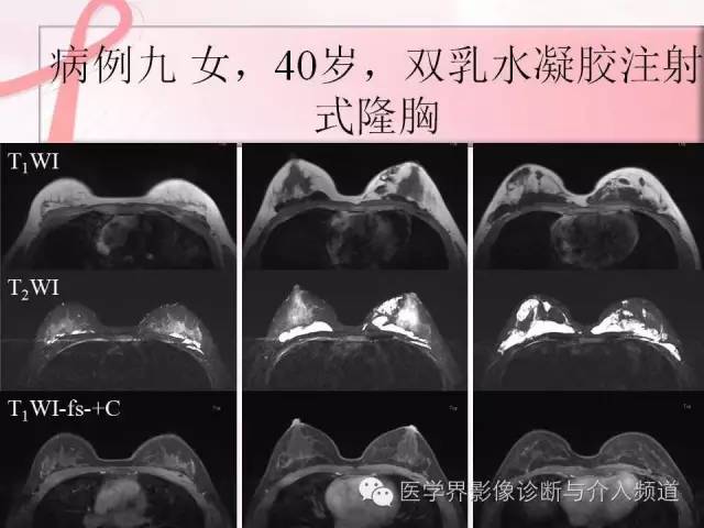 【PPT】隆乳术及其MRI表现