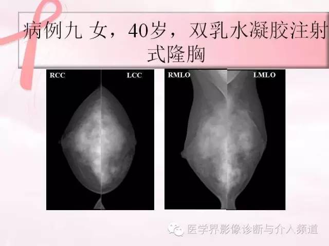 【PPT】隆乳术及其MRI表现