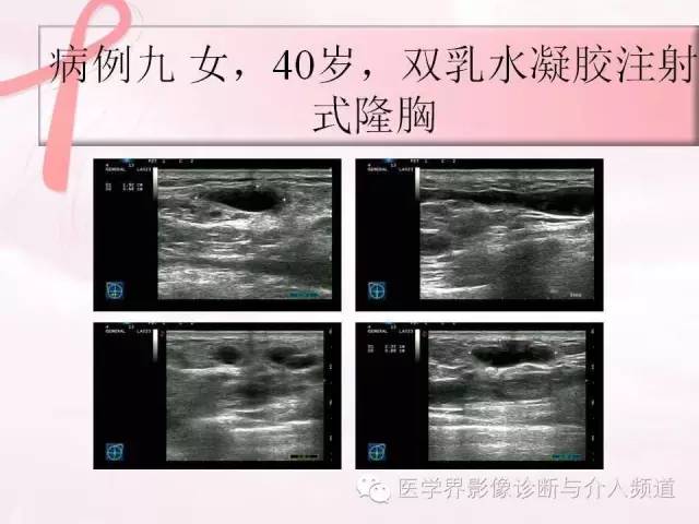 【PPT】隆乳术及其MRI表现