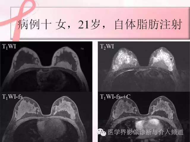 【PPT】隆乳术及其MRI表现