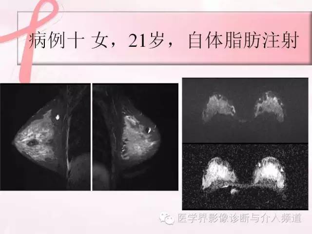 【PPT】隆乳术及其MRI表现