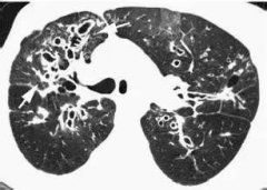 胸部CT常见征象详解|树芽征
