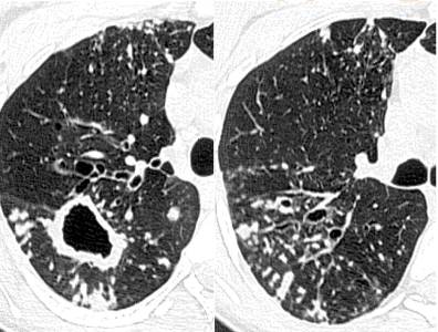 胸部CT常见征象详解|树芽征