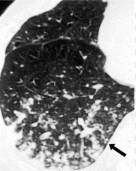 胸部CT常见征象详解|树芽征