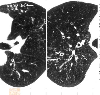 胸部CT常见征象详解|树芽征