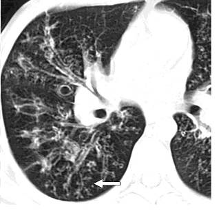 胸部CT常见征象详解|树芽征