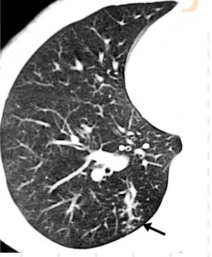 胸部CT常见征象详解|树芽征