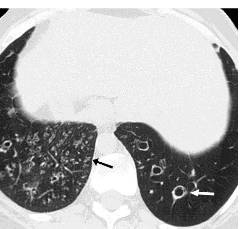 胸部CT常见征象详解|树芽征