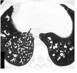 胸部CT常见征象详解|树芽征