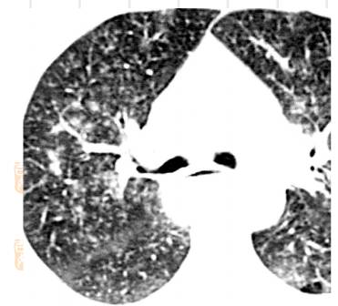 胸部CT常见征象详解|树芽征