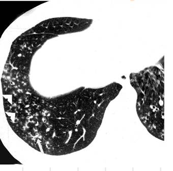 胸部CT常见征象详解|树芽征